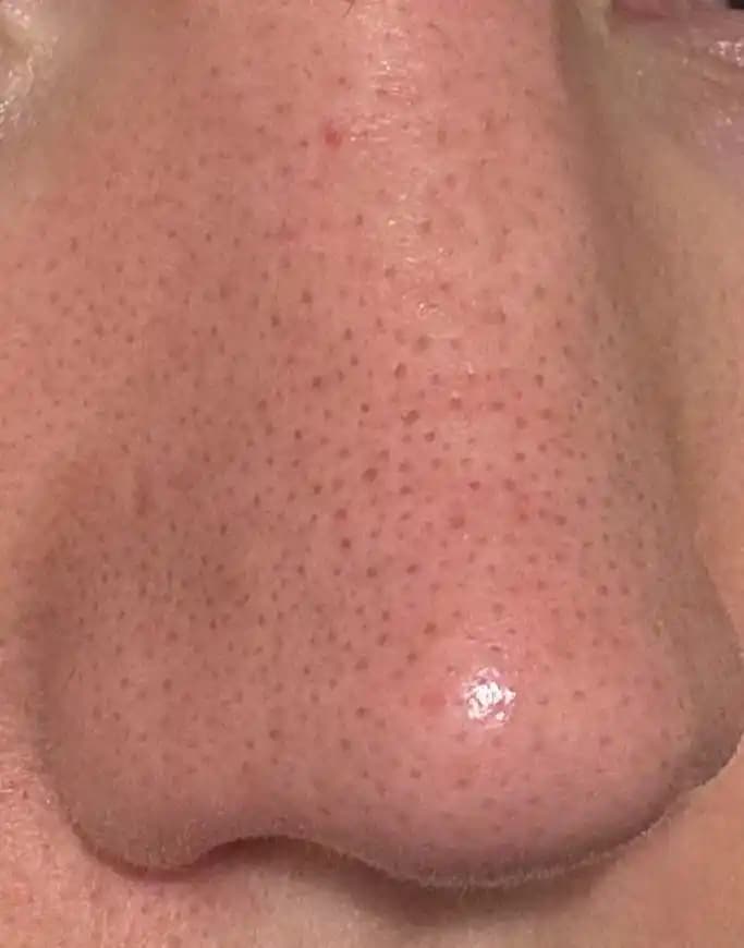 Sebase Filamentler ve Siyah Noktaların Tedavisinde Etkili Cilt Bakım Yöntemleri ve Ürünleri