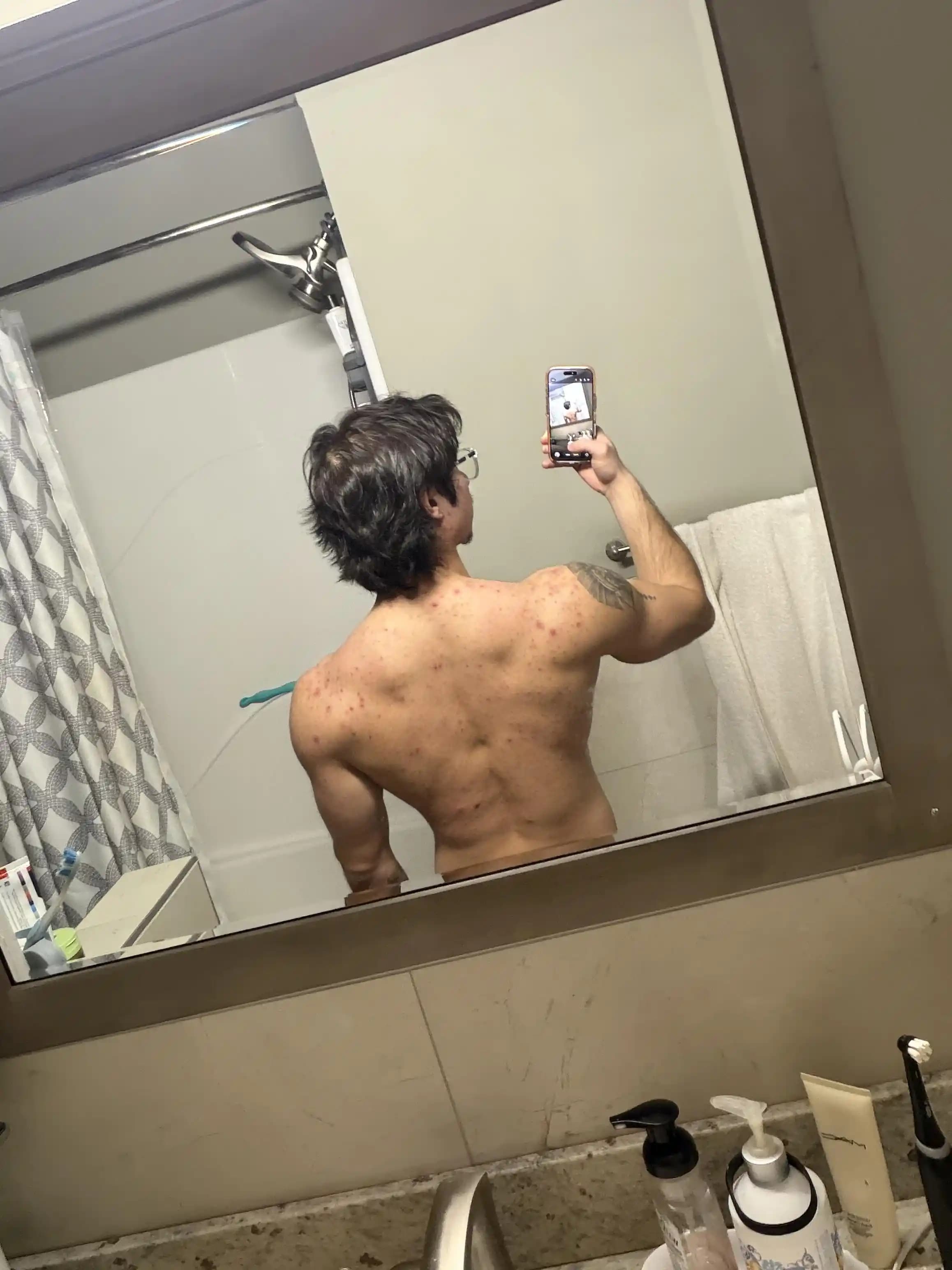 Sırt Aknesi Nedenleri, Tedavi Yöntemleri ve Önleme Stratejileri Hakkında Kapsamlı Rehber