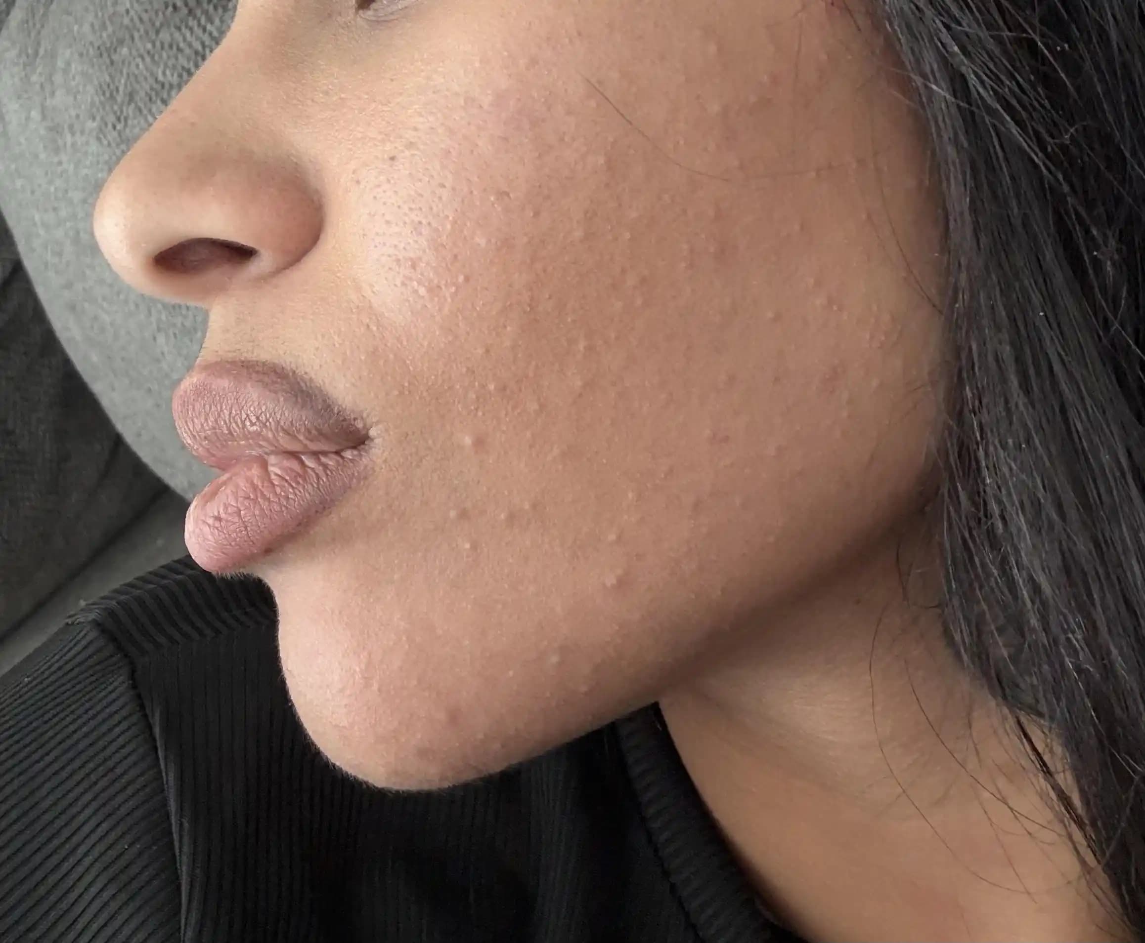 Sivilce ve Cilt Sorunları İçin Etkili Bakım Yöntemleri ve Tedavi Seçenekleri