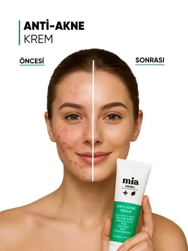 Akne ile Mücadelede Etkili Yöntemler ve Doğru Ürün Kullanımı Rehberi