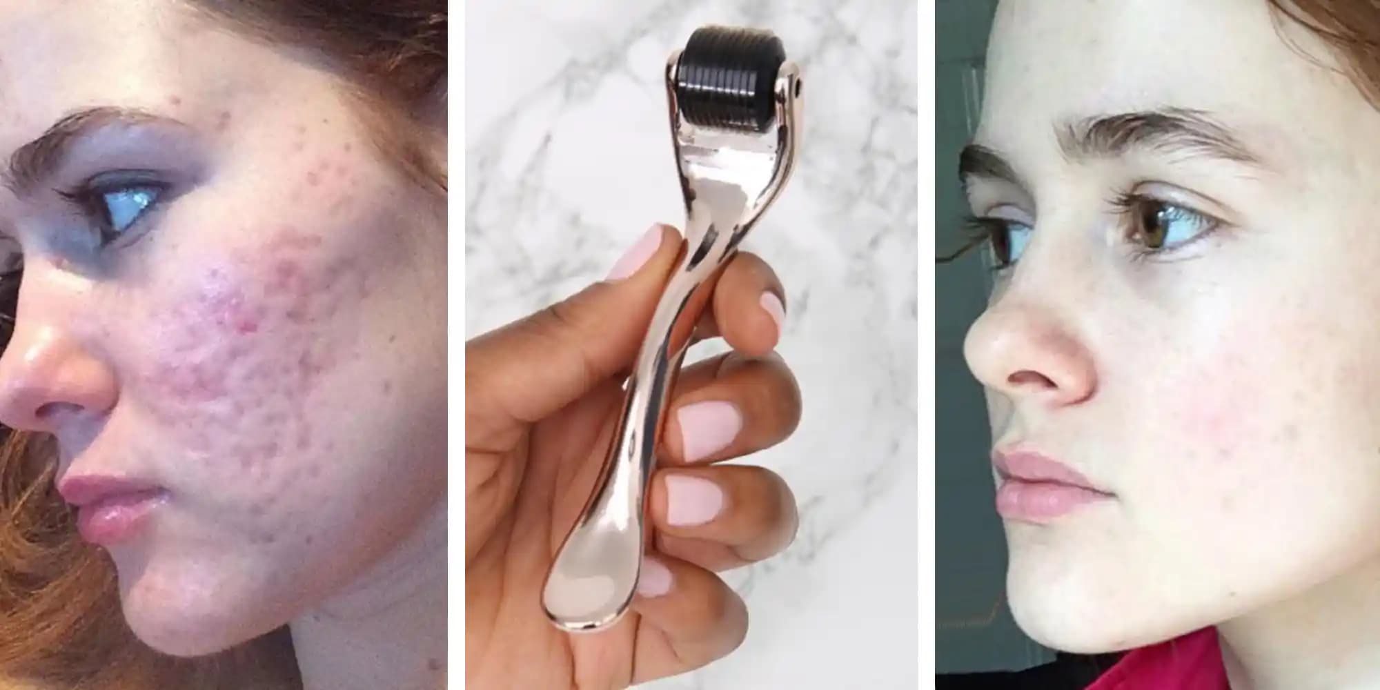 Akne İzleri İçin Dermaroller Kullanımı: Doğru Seçim ve Uygulama İpuçları