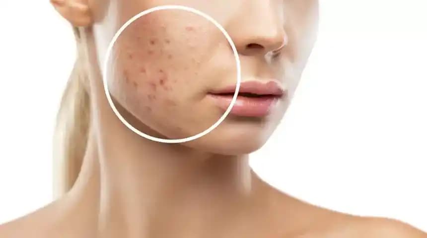 Akne, Kızarıklık ve Hiperpigmentasyon Tedavisinde Güncel Yaklaşımlar ve Ürün Seçenekleri