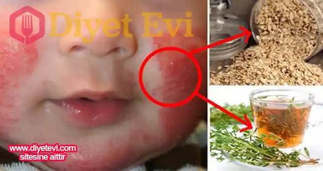 Allerjik Pişik Nedir, Belirtileri, Tedavi Yöntemleri ve Bakım İpuçları