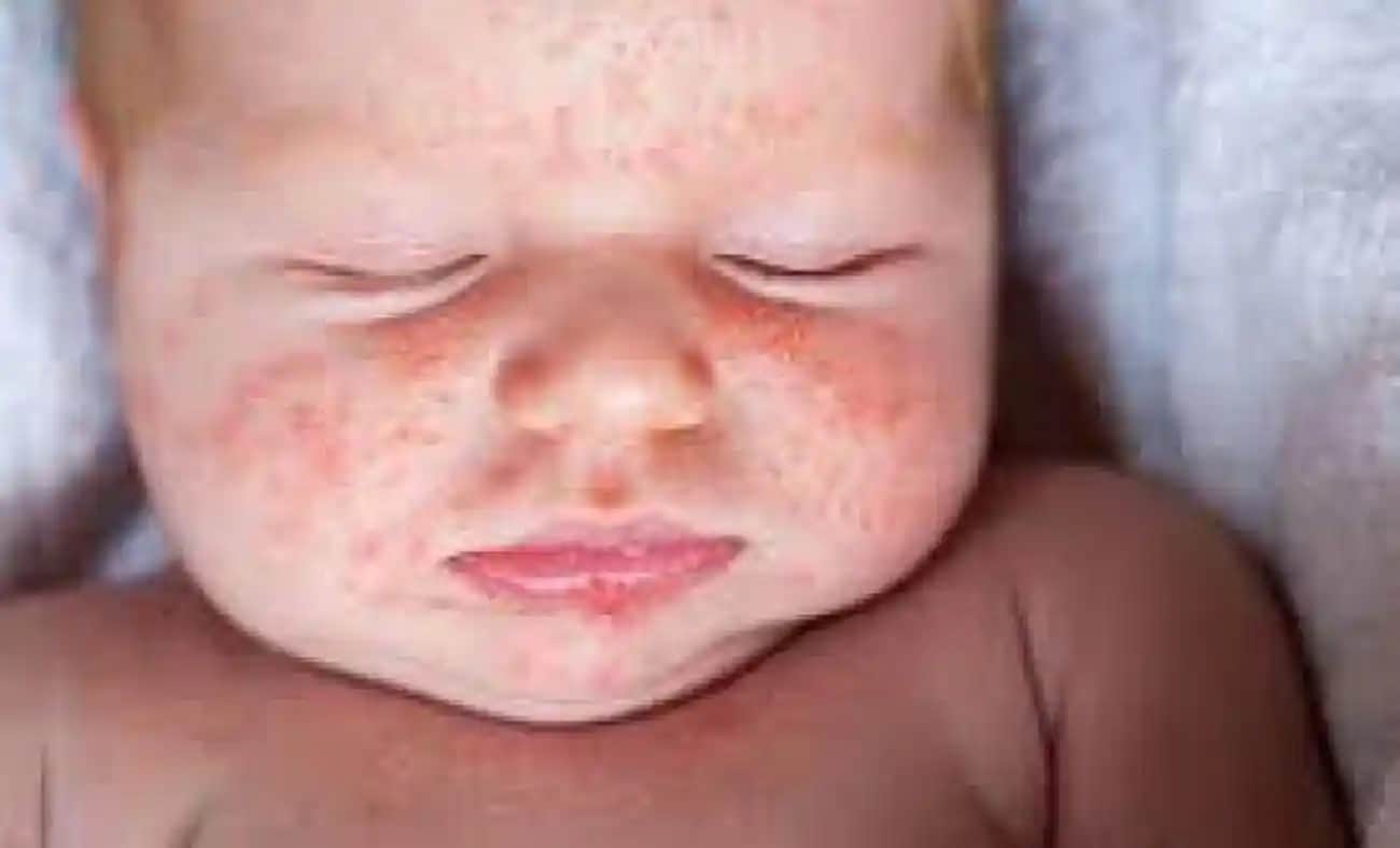 Bebeklerde Pişiğe İyi Gelen Doğal Yöntemler ve Pişiği Önlemenin En Etkili Yolları