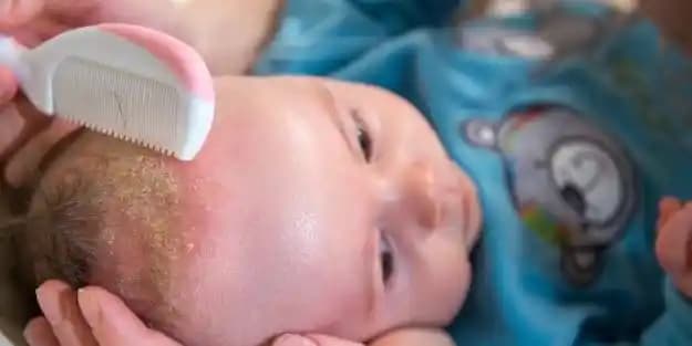 Bebeklerde Saç Derisinde Kabuklanma Nedenleri ve Doğru Bakım Yöntemleri