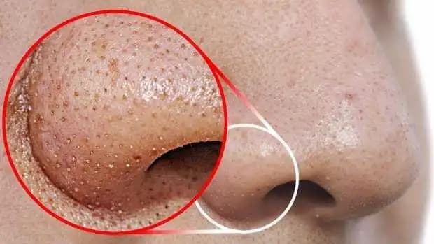Burundaki Siyah Noktalara Karşı Etkili ve Kalıcı Çözüm Yolları Rehberi