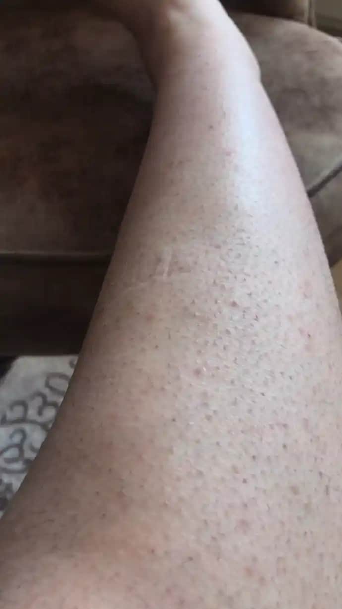 Çilek Bacak Sorunu ve Doğru Yaklaşımlar: Estetik ve Sağlık Arasında Deneyimler