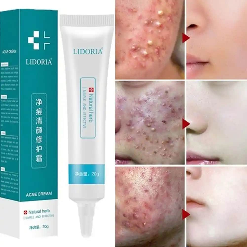 Cilt Lekesi Kremi Seçimi ve Etkili Çözüm Yolları Rehberi