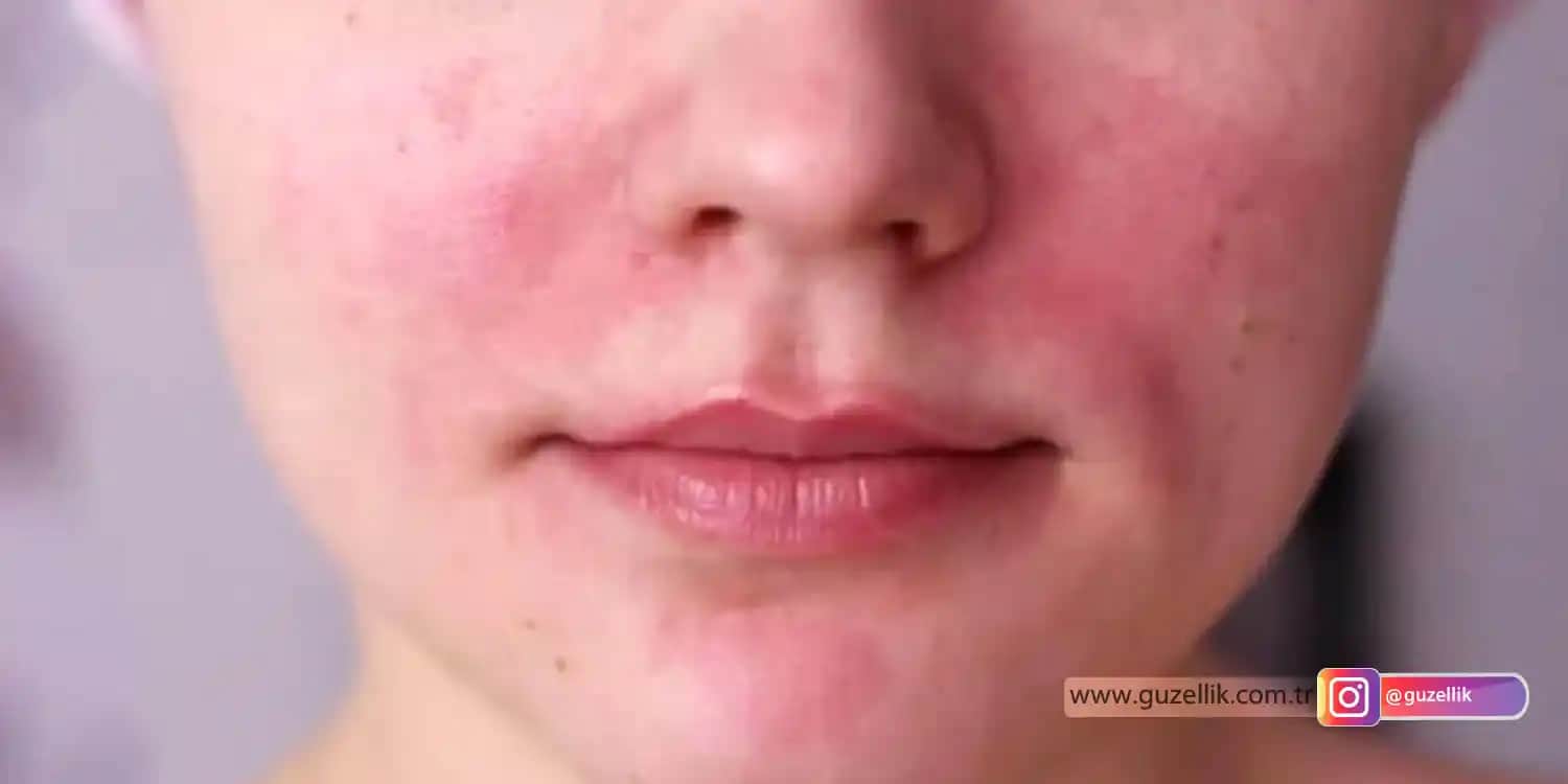 Ciltte Kızarıklık Nedenleri, Belirtileri ve Etkili Çözüm Yolları