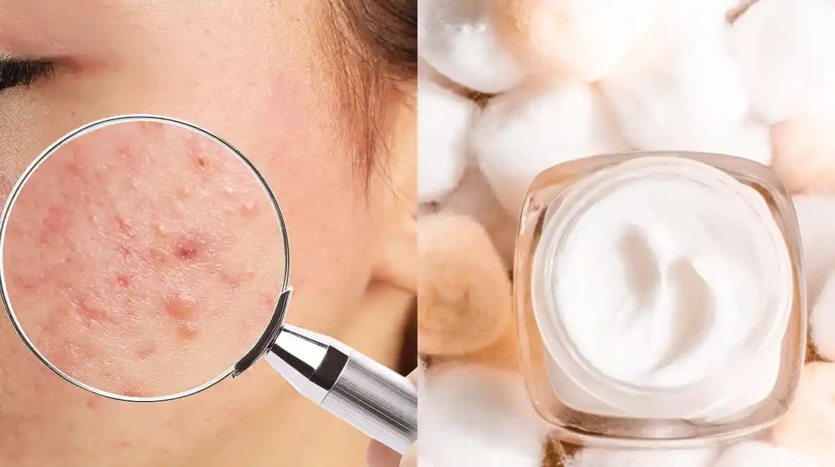 Deri Altı Sivilcelerle 2025'te Etkili Mücadele: En İyi Kremler ve Yöntemler