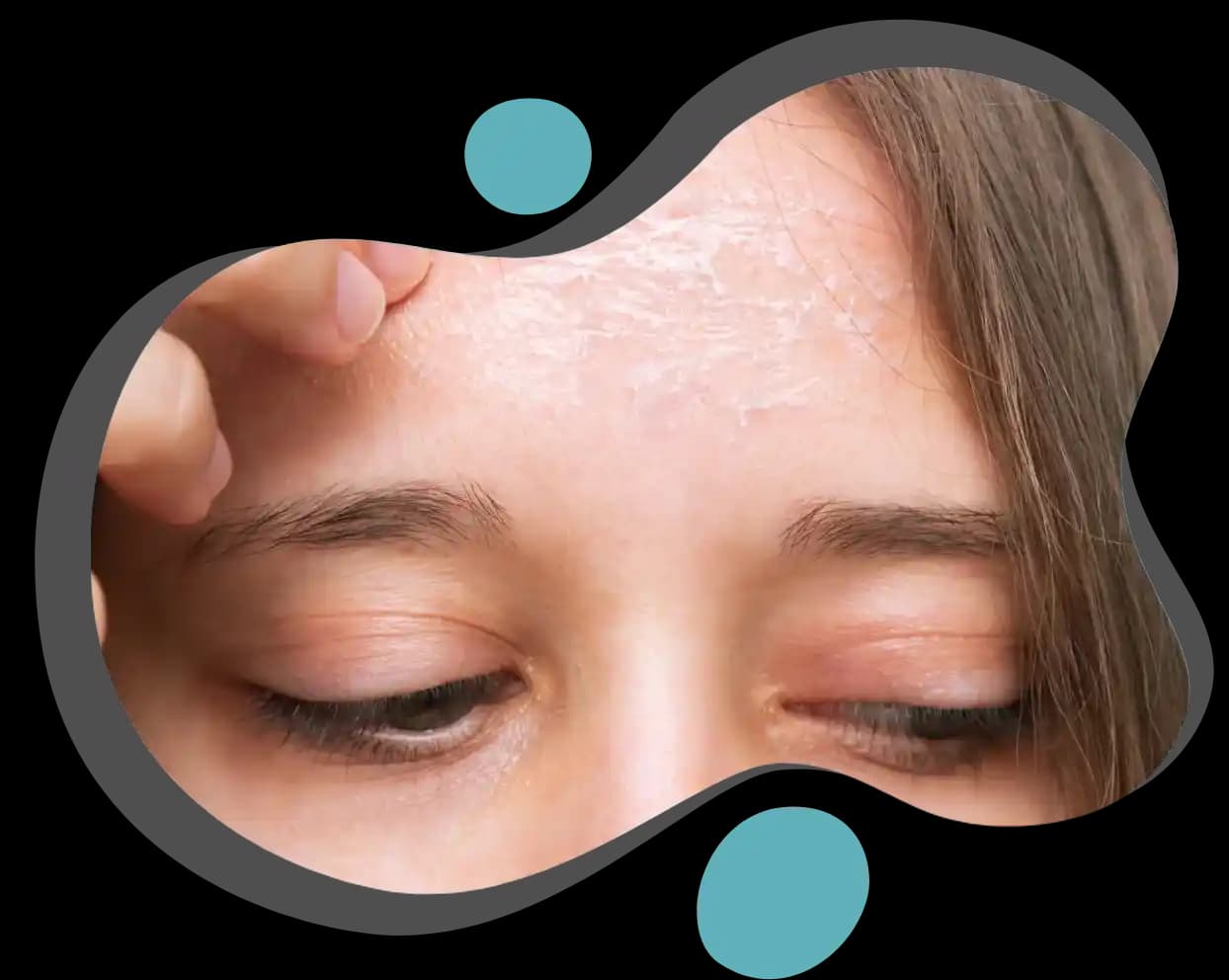 Ciltte Pullanma Nedenleri, Tedavi Yöntemleri ve Korunma İpuçları