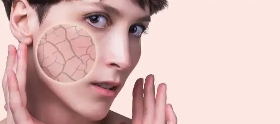 Ergenlerde Vücut Çatlaklarının Nedenleri ve Etkili Tedavi Yöntemleri