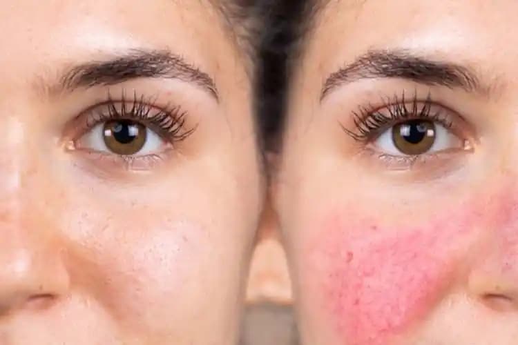 Gül Hastalığına Karşı Etkili Kremler ve Cilt Bakım Yöntemleri