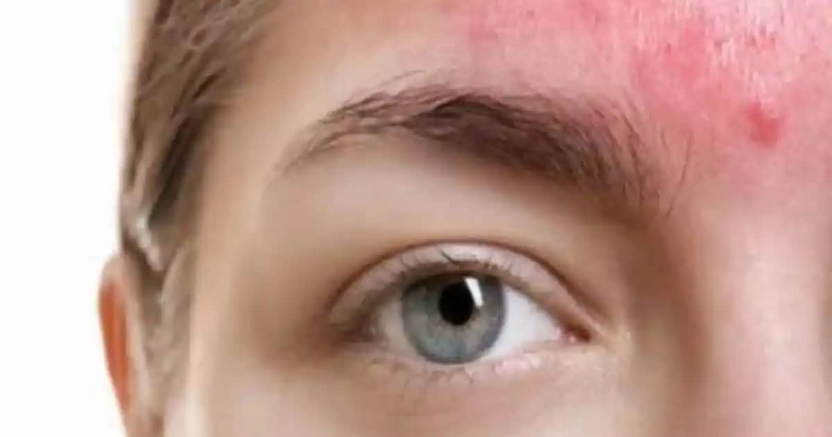 Hassas Ciltlerde Kızarıklık Nasıl Azaltılır ve Doğru Bakım Yöntemleri