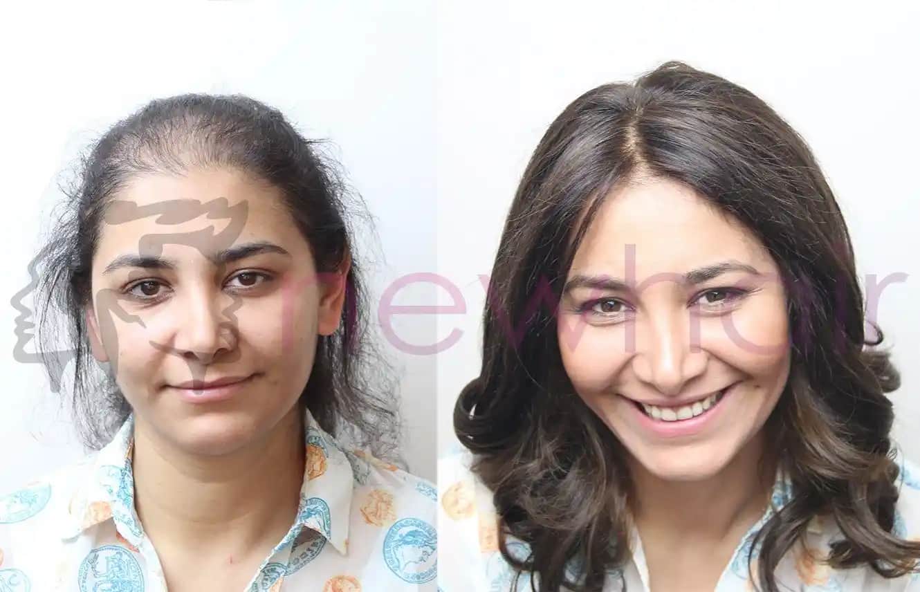 Kadınlar İçin Protez Saç: Doğal Görünüm ve Kalıcı Çözüm Yöntemleri