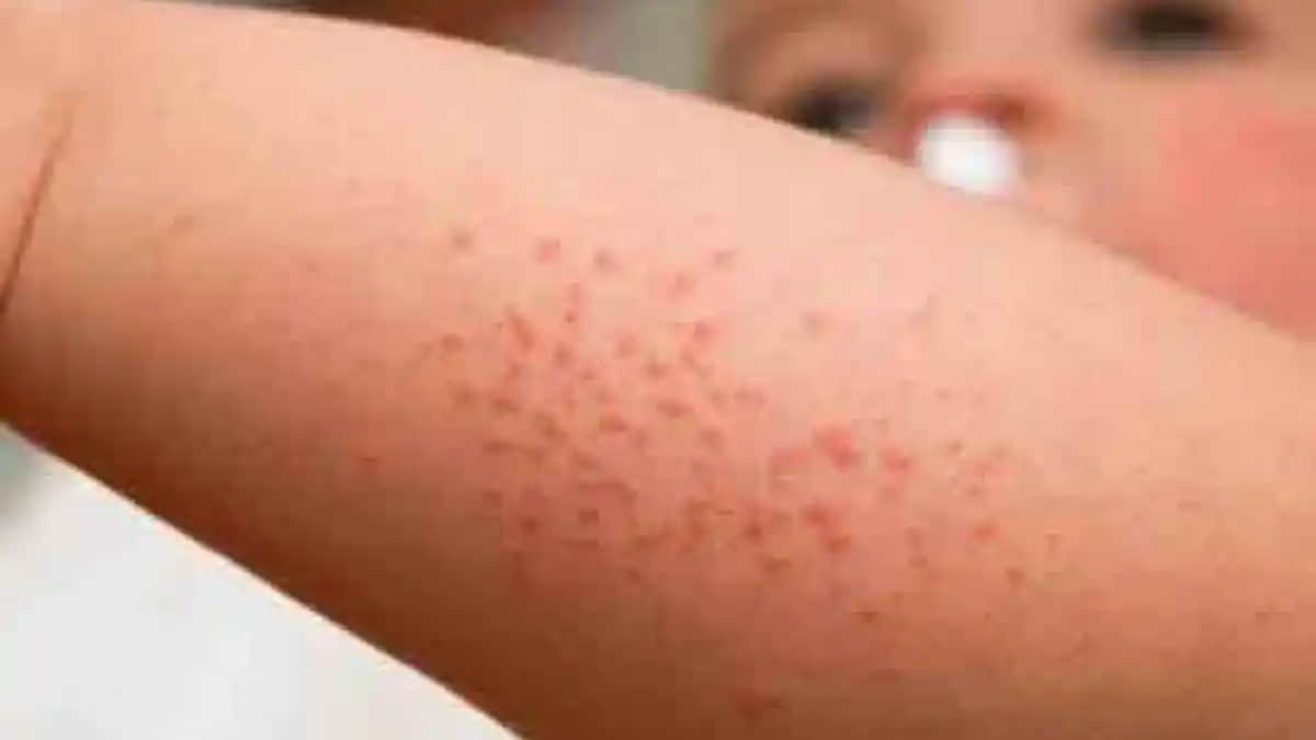 Koltuk Altı Pişiği Nedenleri ve Doğal Tedavi Yöntemleri Hakkında Bilgiler