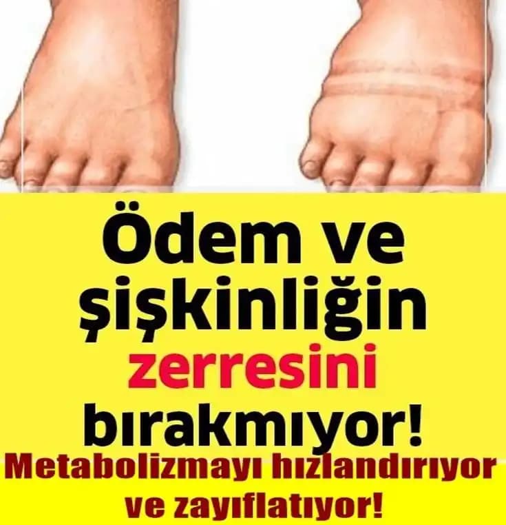Ödemle Mücadelede Etkili İlaçlar ve Doğal Çözümler Hakkında Bilmeniz Gerekenler