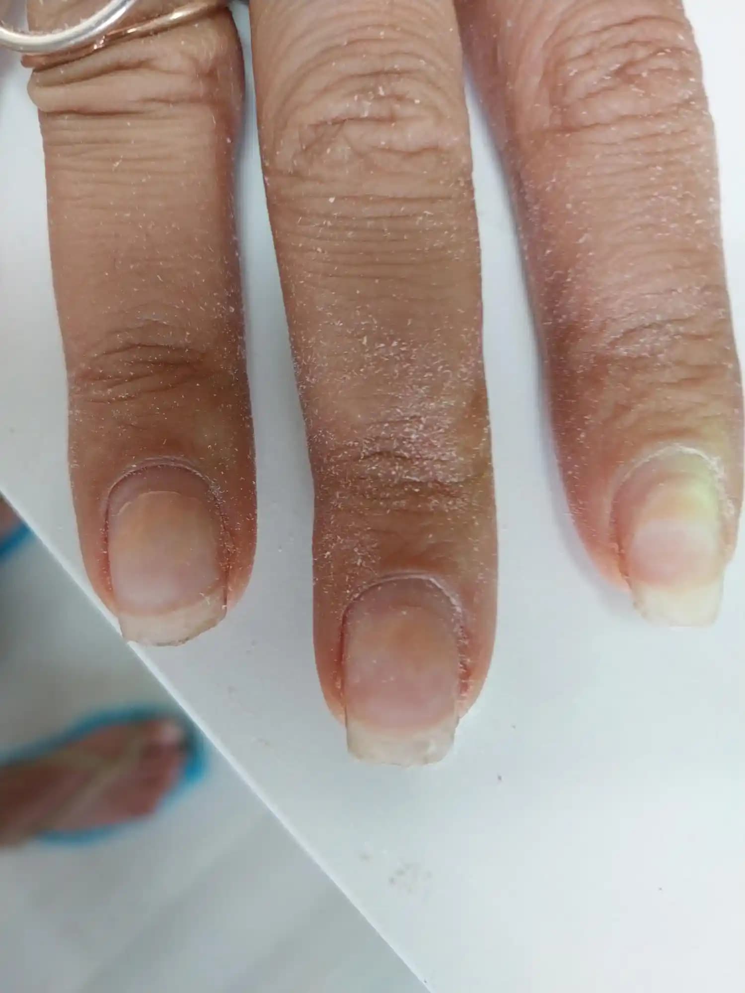 Protez Tırnak Sonrası Mantar Sorunu ve Doğru Bakım Yöntemleri Hakkında Bilgilendirme