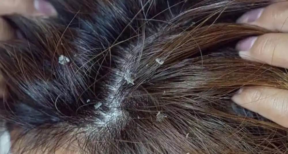 Saç Derisinde Kabuklanma Nedenleri ve En Etkili Tedavi Yöntemleri Hakkında Bilgi