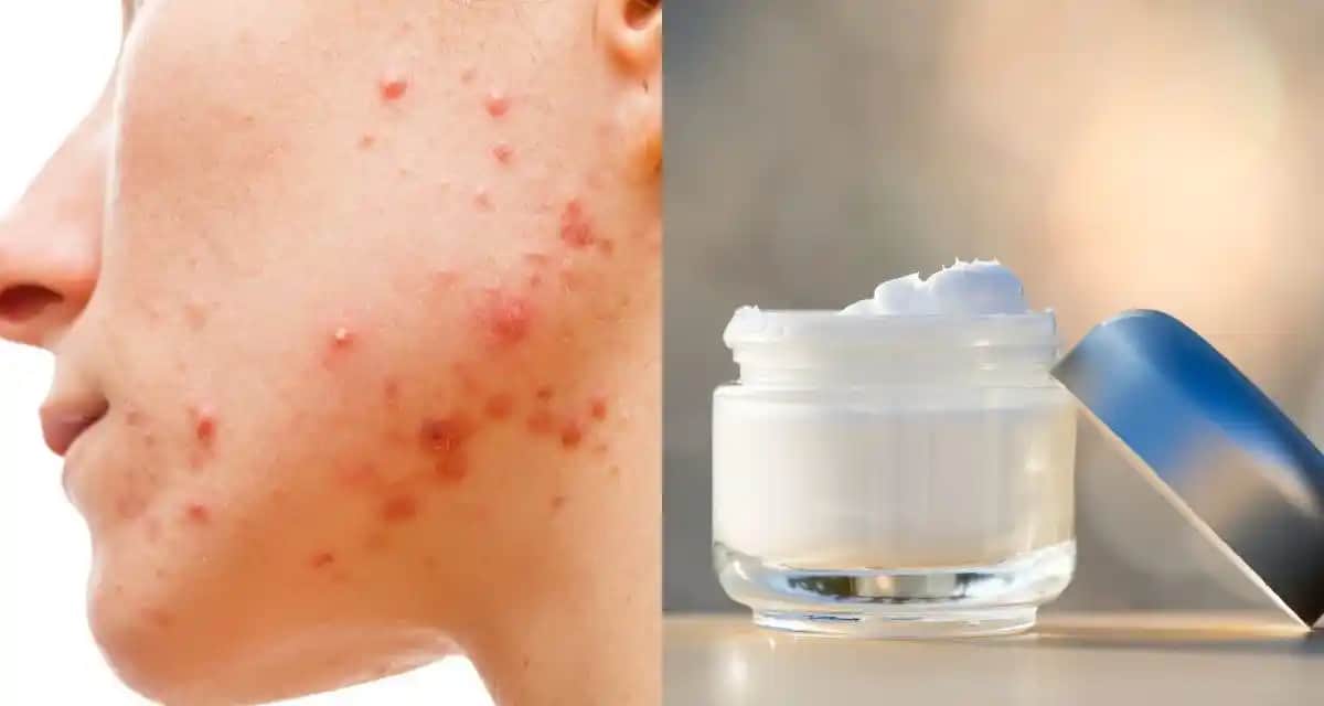 Sivilce Kremi Rehberi: En Etkili Ürünler ve Cilt Sağlığı İçin Doğru Seçenekler