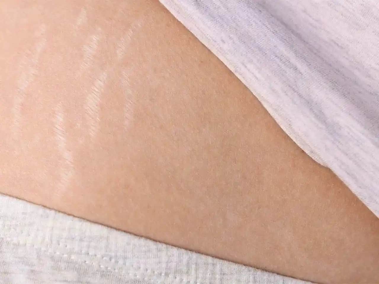 Vücutta Çatlak Nedenleri ve Çözüm Yolları Hakkında Kapsamlı Rehber