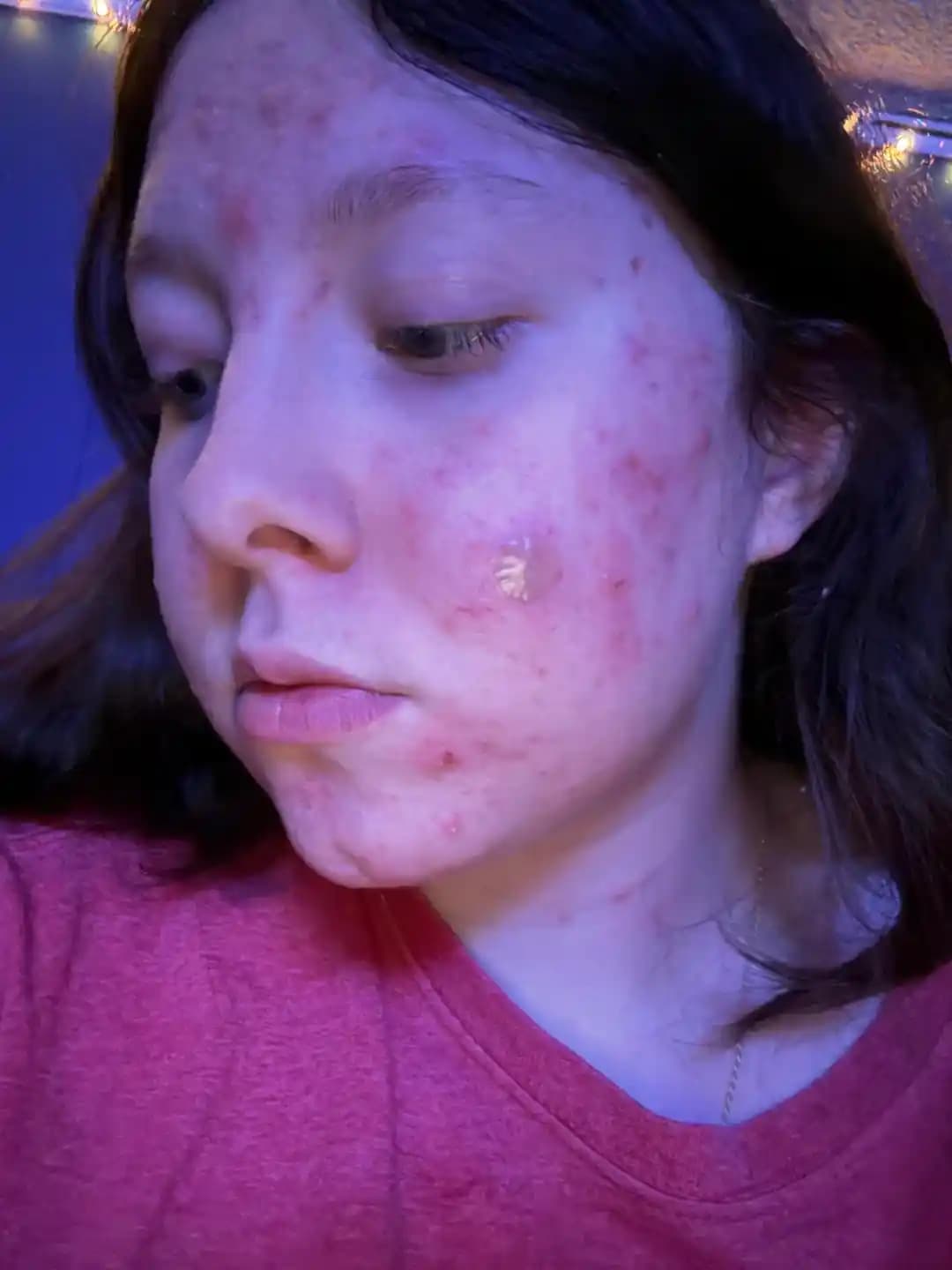 Akne Tedavisinde Dermatolojik Yöntemler ve Psikolojik Destek Yaklaşımları