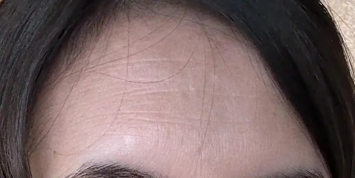 Alın Kırışıklıklarının Geri Döndürülebilirliği ve Etkili Bakım Yöntemleri