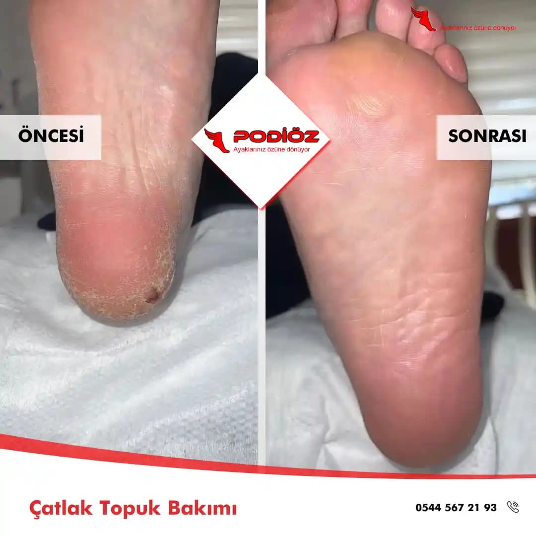 Derin Çatlak Topukların Nedenleri, Genetik ve Ayak Yapısının Rolü ile Yönetimi