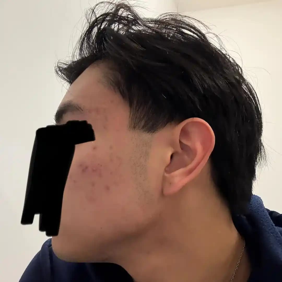 Hormonal Akne Tedavisinde Basit ve Düzenli Cilt Bakımının Önemi ve Etkili İlaç Kullanımı