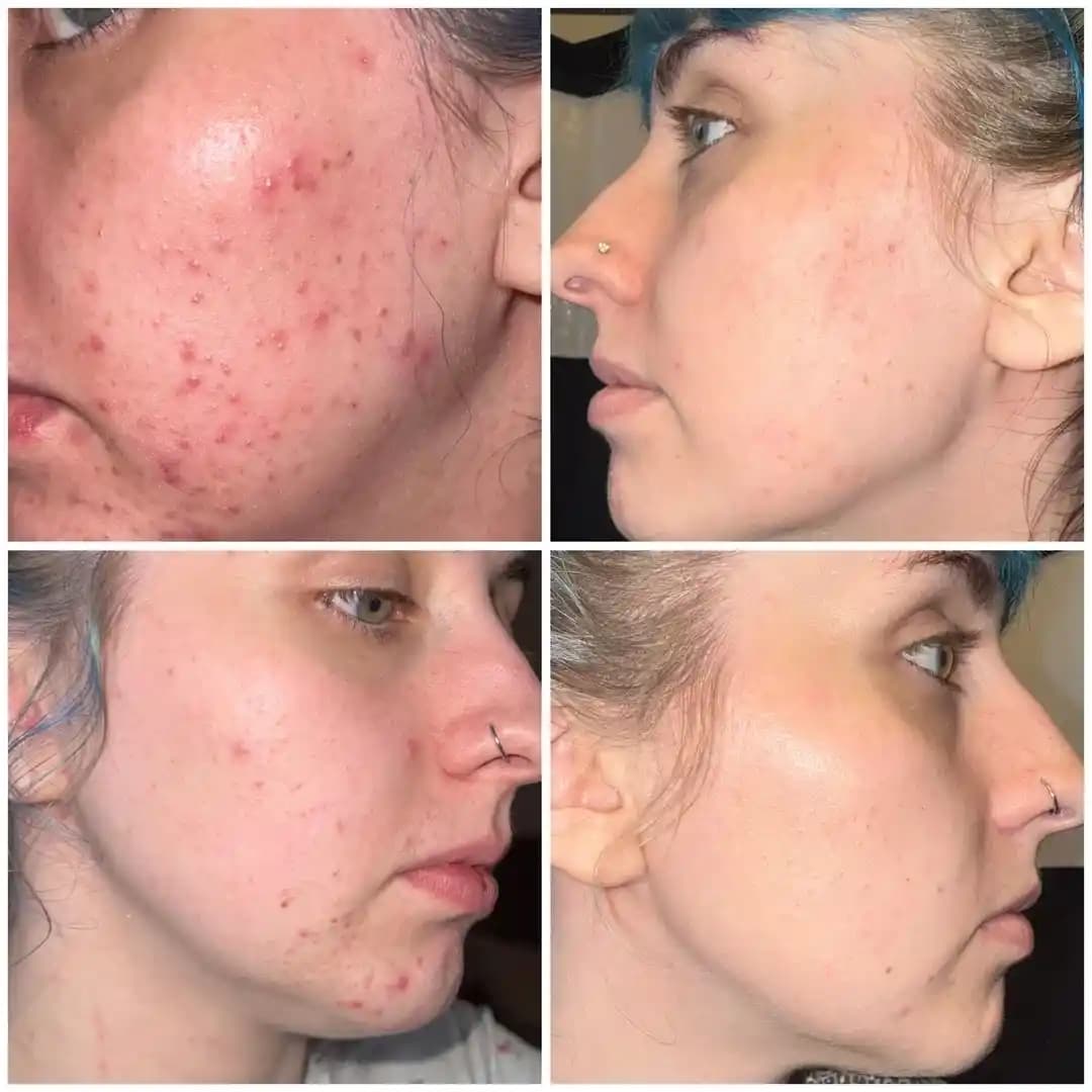 Hormonal Akne Tedavisinde Spironolaktonun Etkisi ve Kullanım Rehberi