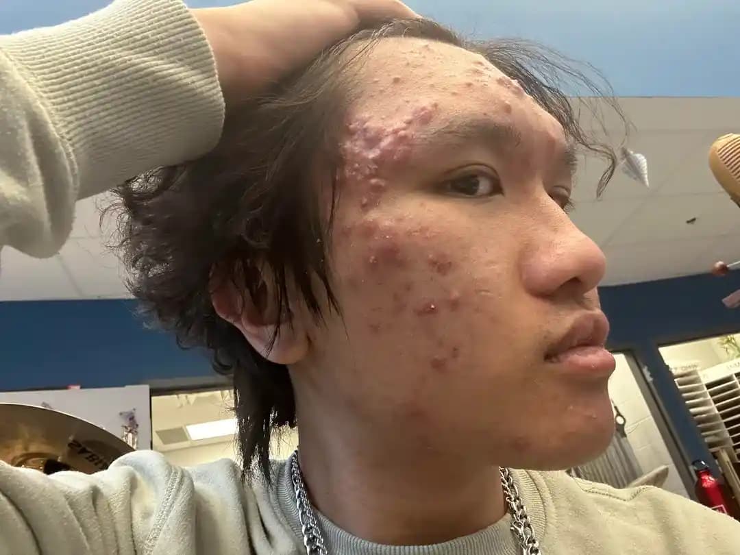 İlerlemiş Akne Neden Kötüleşir ve Etkili Tedavi Yöntemleri Nelerdir?