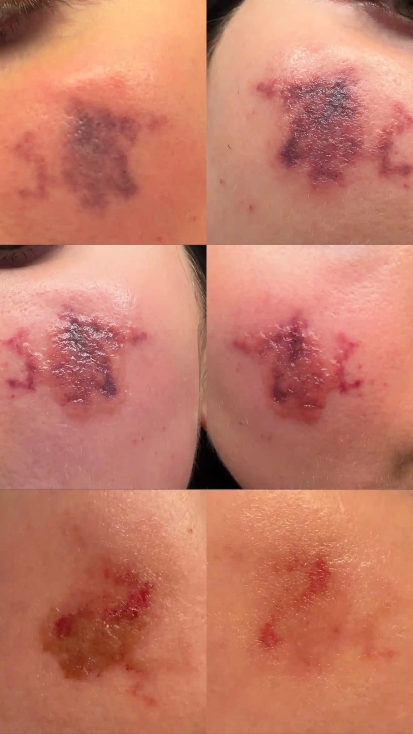 IPL Tedavilerinde Yanık Riski, Nedenleri ve Sonrası Bakım Önerileri