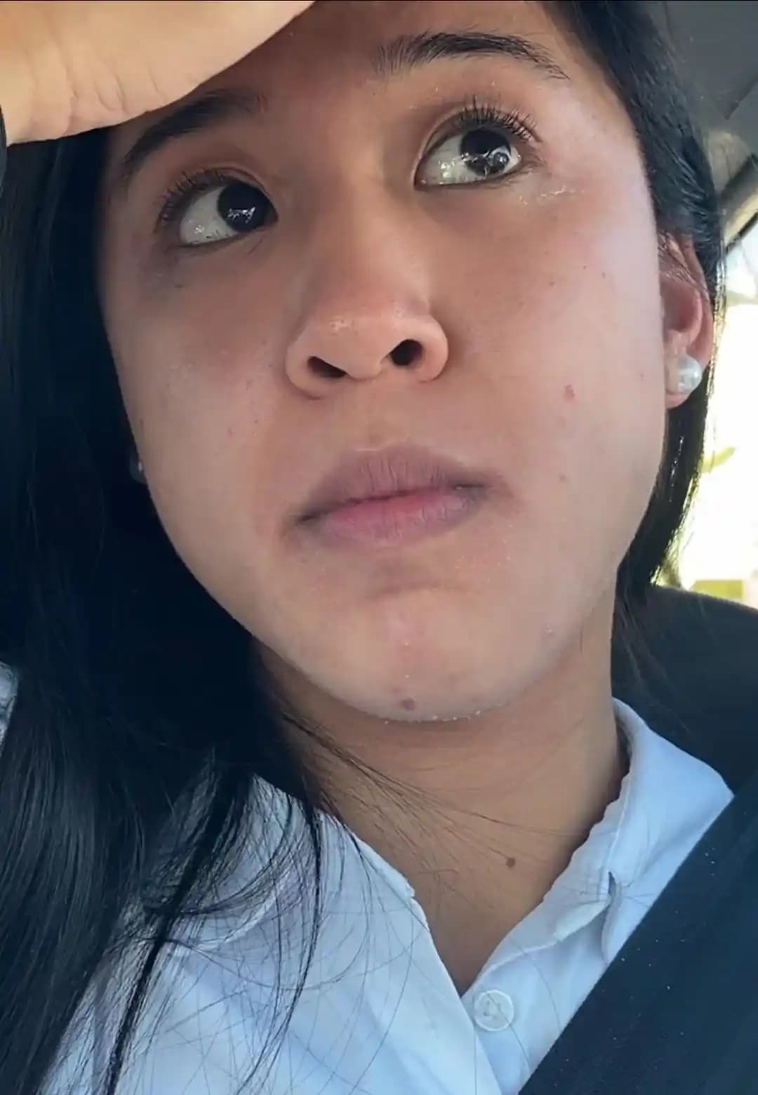 2020-2025 Arası Hormonal Akne ve Cilt Bakım Süreci: Tedavi Yöntemleri ve Yaşam Tarzı Değişiklikleri