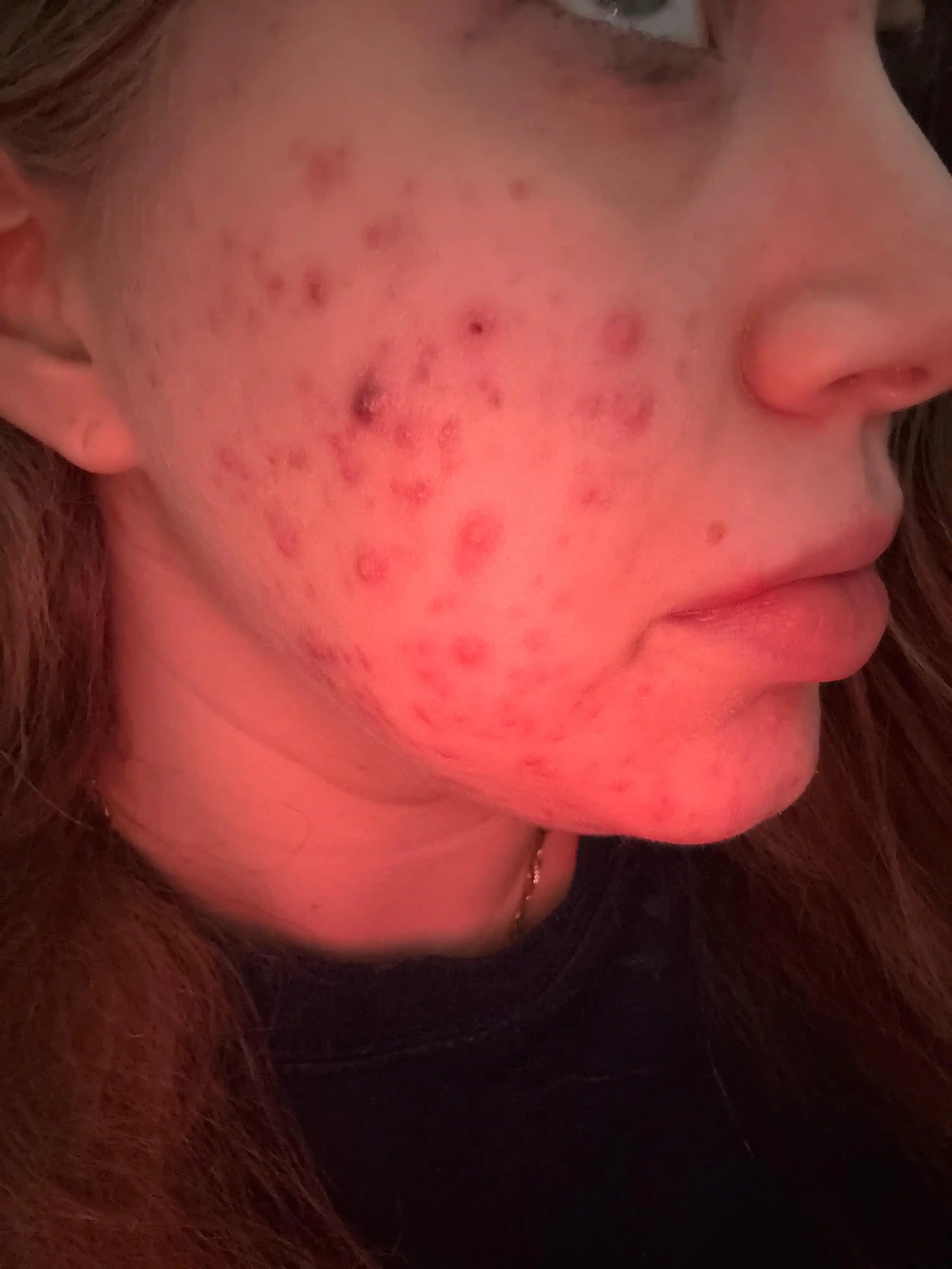 Akne Tedavisinde Etkili Yöntemler, İlaçlar ve Kullanıcı Deneyimleri Üzerine İnceleme