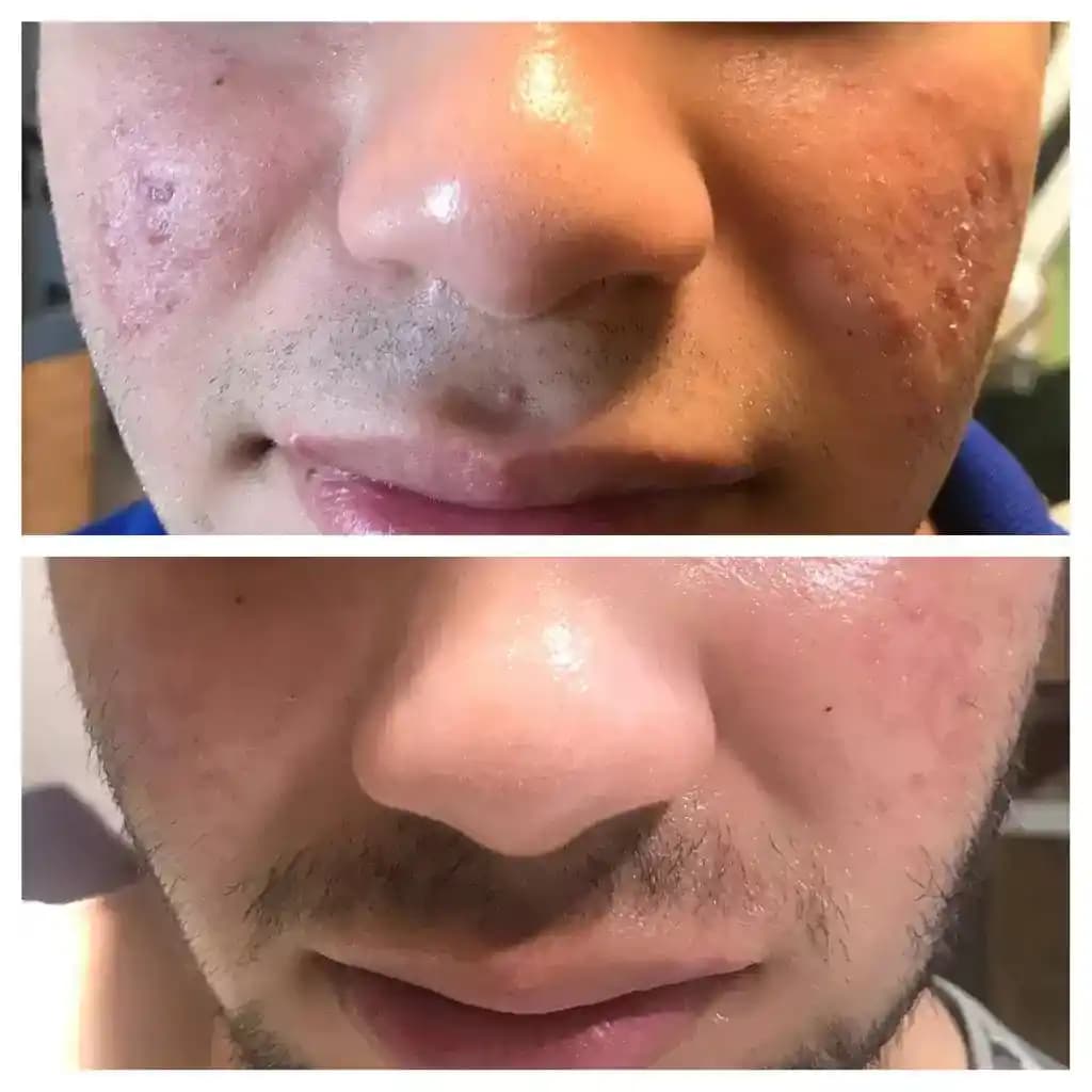 Akne Tedavisinde Kullanılan İlaçların Yan Etkileri ve Dikkat Edilmesi Gerekenler