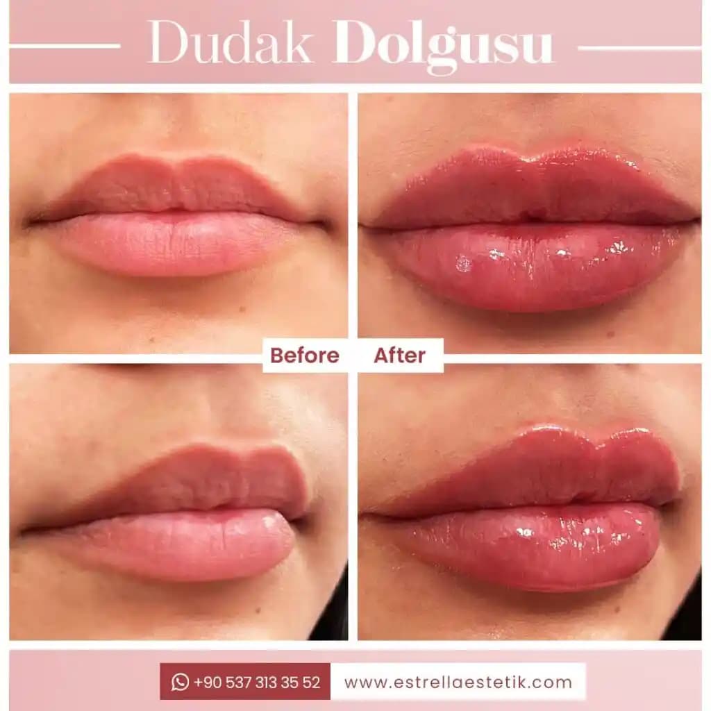 Dudak Dolgusu Sonrası Görünüm ve Değerlendirme: Doğallık ve İyileşme Süreci