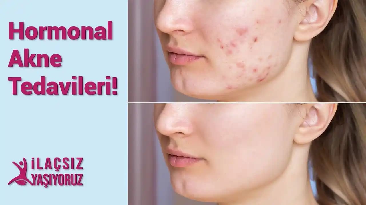 Hormonal Aknenin Temel Nedeni: Stres ve Travmanın Cilt Sağlığı Üzerindeki Etkileri