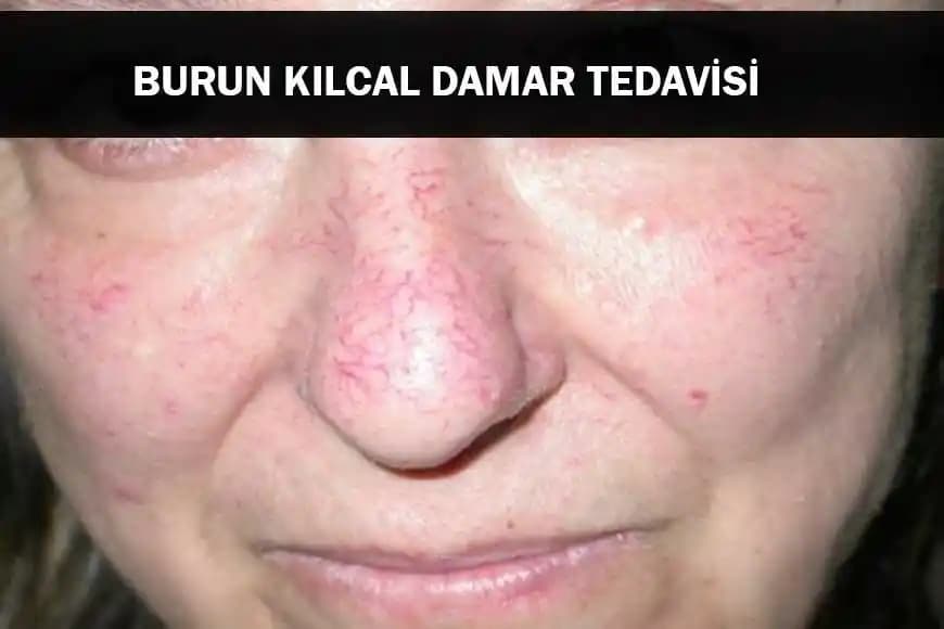 Kırık Kılcal Damarların Tedavi Yöntemleri ve Etkinlikleri Üzerine Güncel Bilgiler