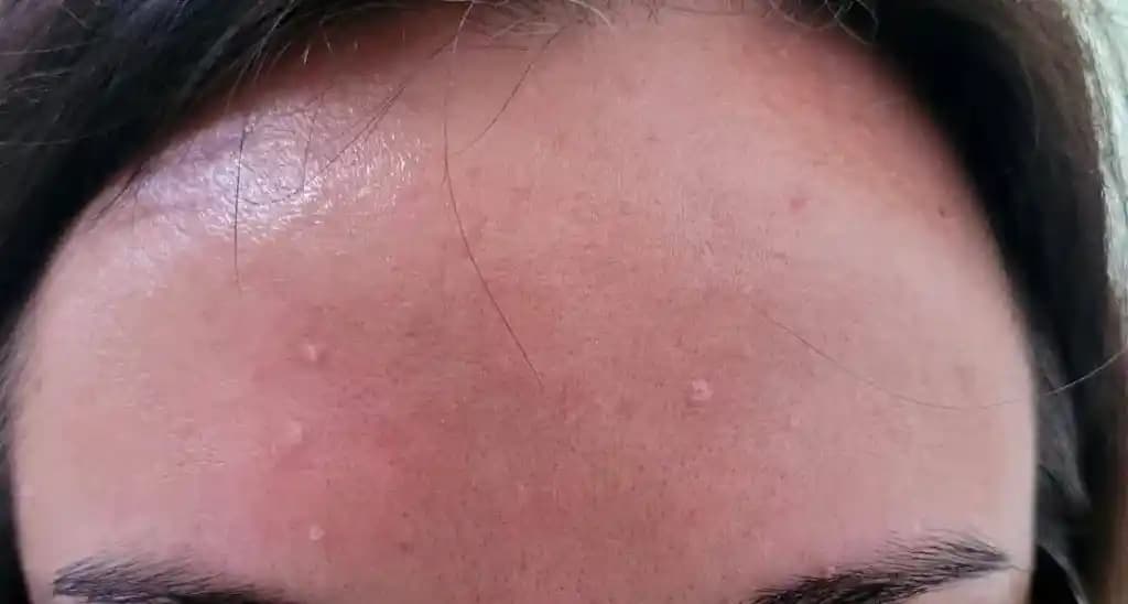 Sebase Filamentler İçin Etkili Ürünler ve Asya Cilt Bakım Yöntemleri