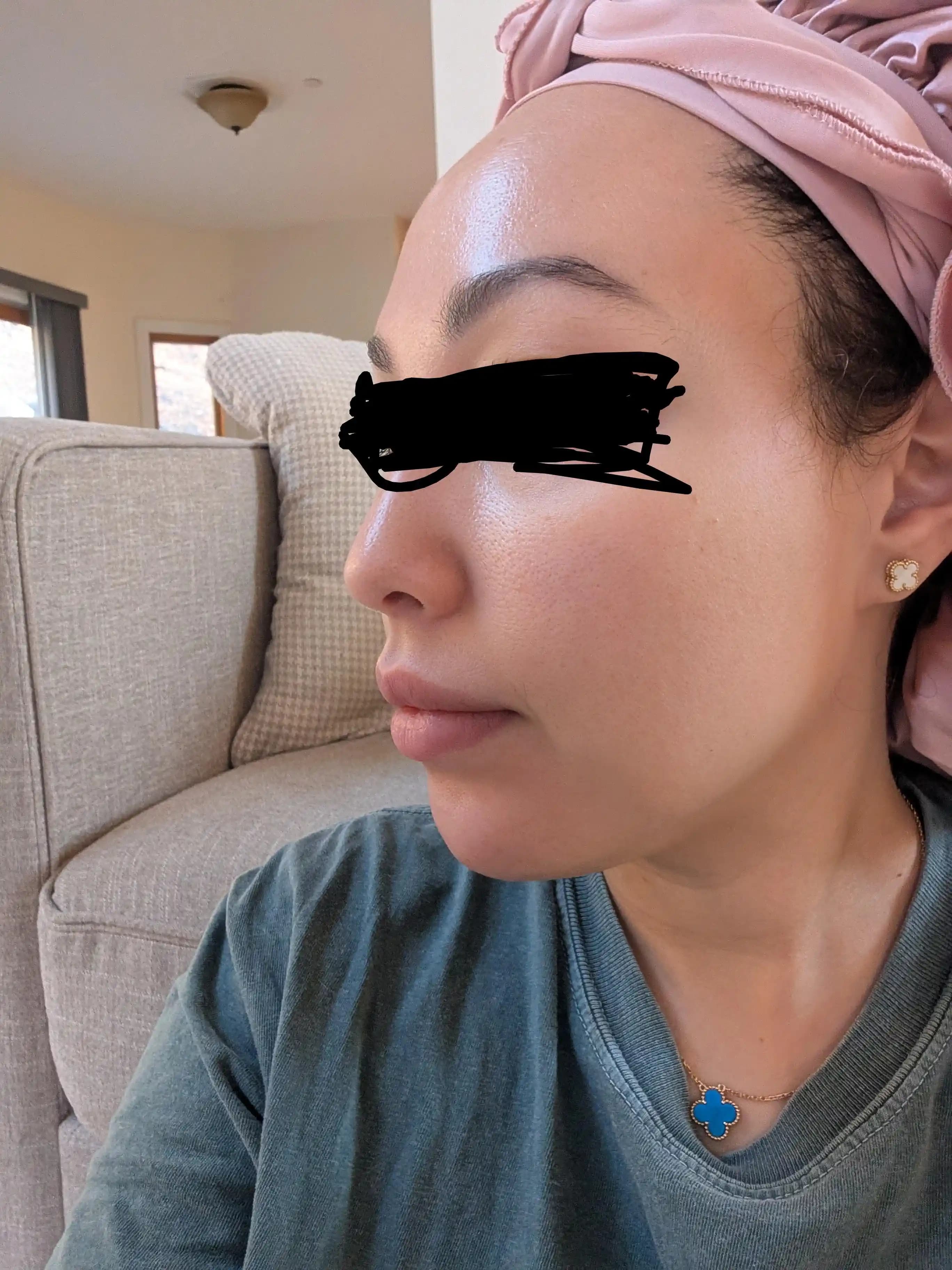 Tretinoin Kullanımında Sandwich Method ile Cilt İyileştirme ve Yan Etkilerin Azaltılması