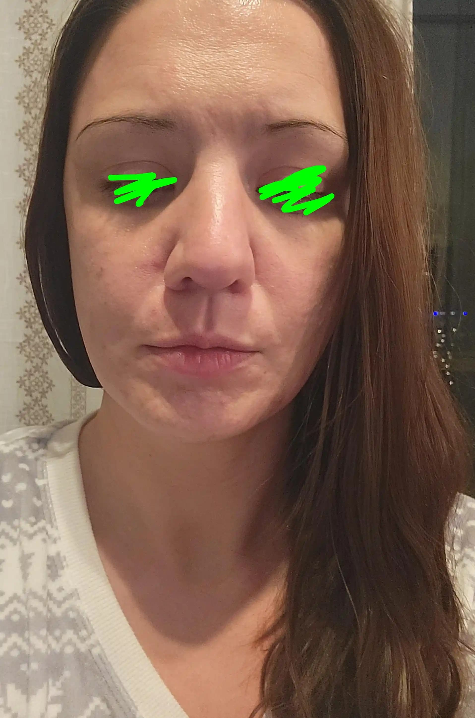 Yüzde Hızlı Yaşlanma ve Şişlik: Nedenleri, Etkileri ve Etkili Çözümler