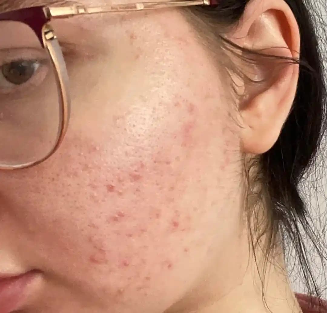 Adapalene Kullanımı ve Ciltteki Etkileri: 8 Haftalık Deneyim ve Uygulama Yöntemleri