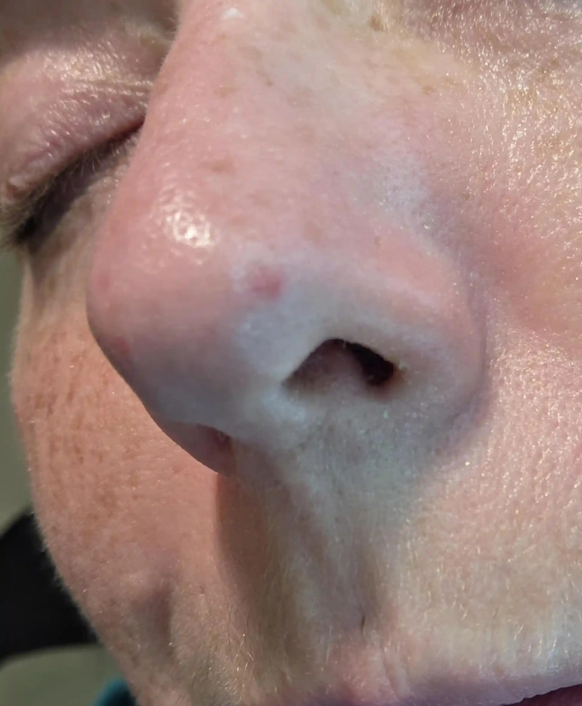 Burundaki Bazal Hücreli Karsinomun Tanımı, Tedavi Yöntemleri ve Uzman Seçimi