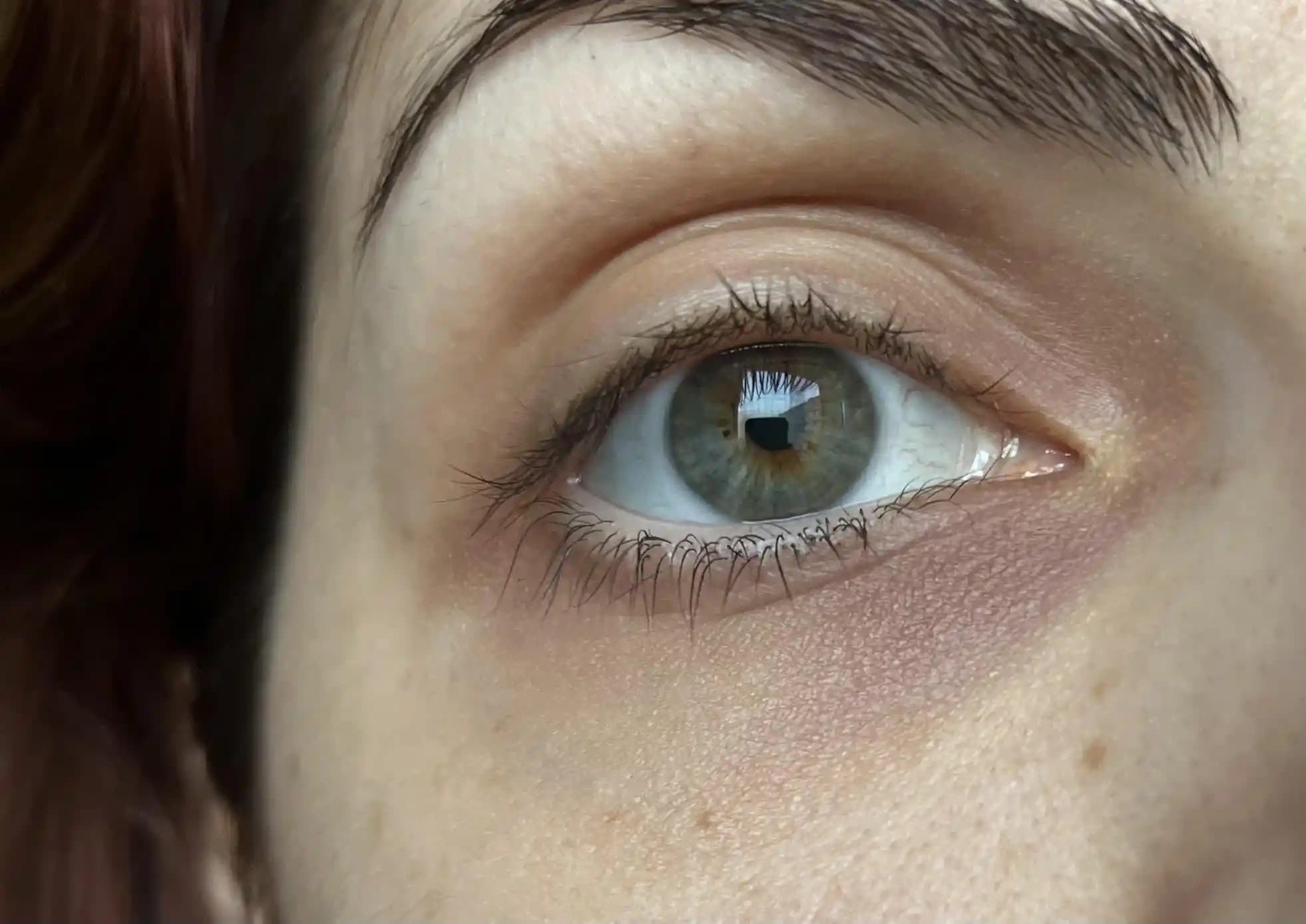 Göz Altı Morluklarının Nedenleri, Tedavi Yöntemleri ve Bakım Önerileri