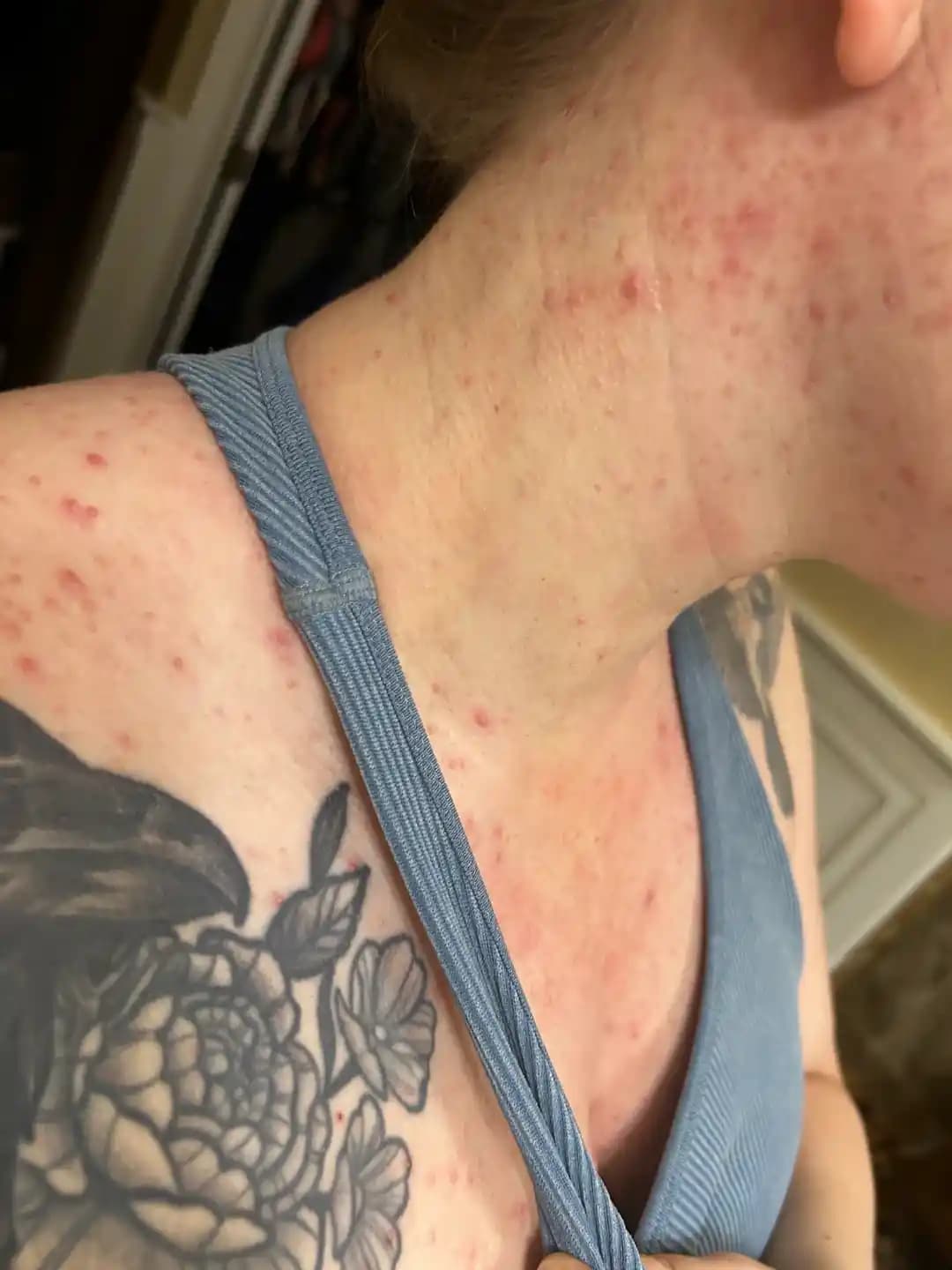 Hamilelikte Şiddetli Akne Problemleri ve Güvenli Yönetim Yöntemleri