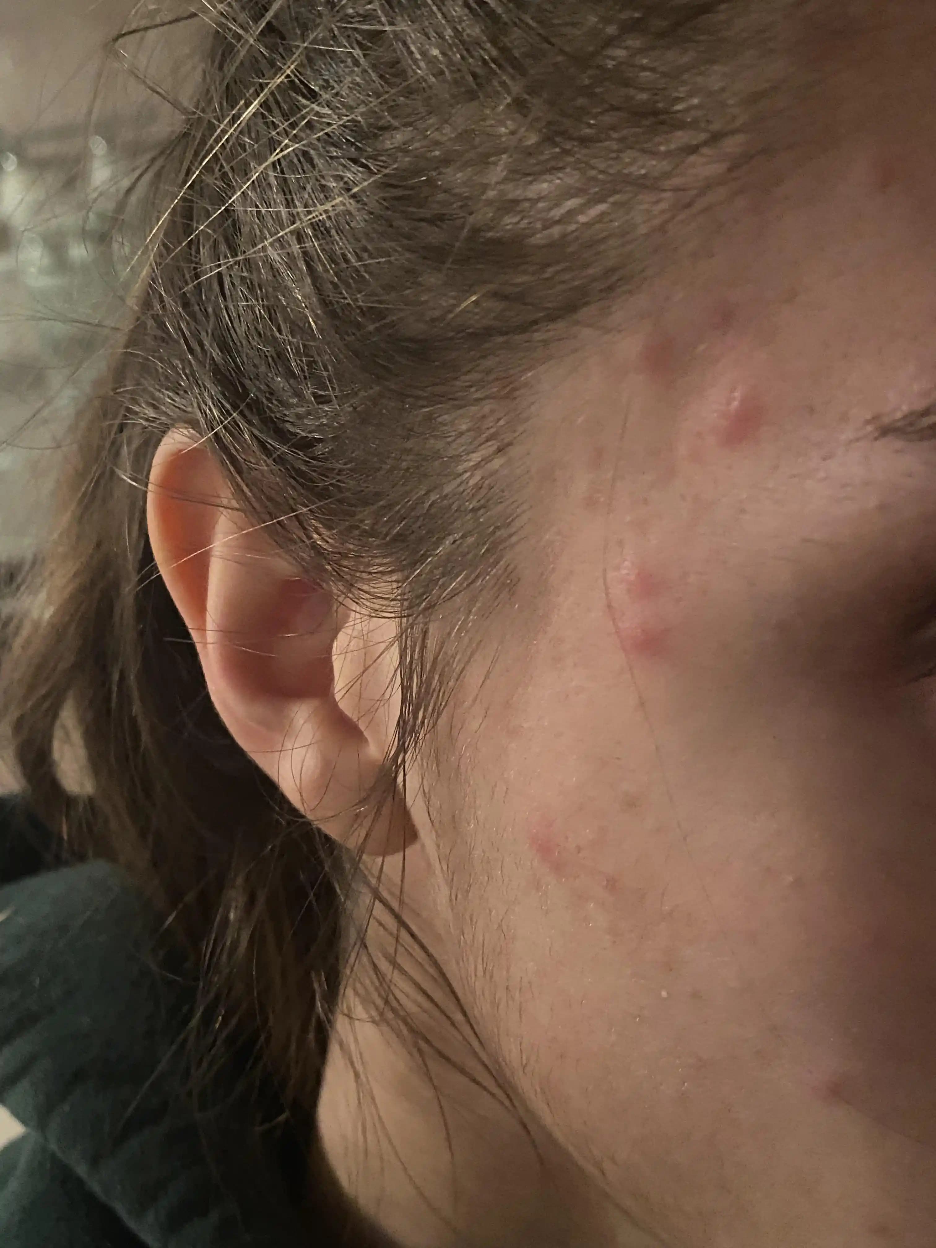 Saç Çizgisi ve Yüzde Aniden Ortaya Çıkan Sert Kabarcıkların Nedenleri ve Tedavi Yöntemleri