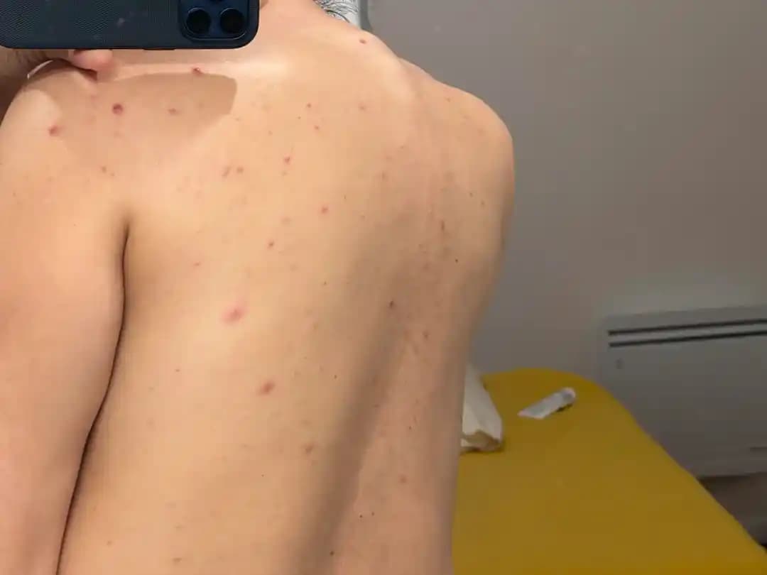 Sırt Aknesi Tedavisinde Etkili Yöntemler ve Dermatolojik Yaklaşımlar