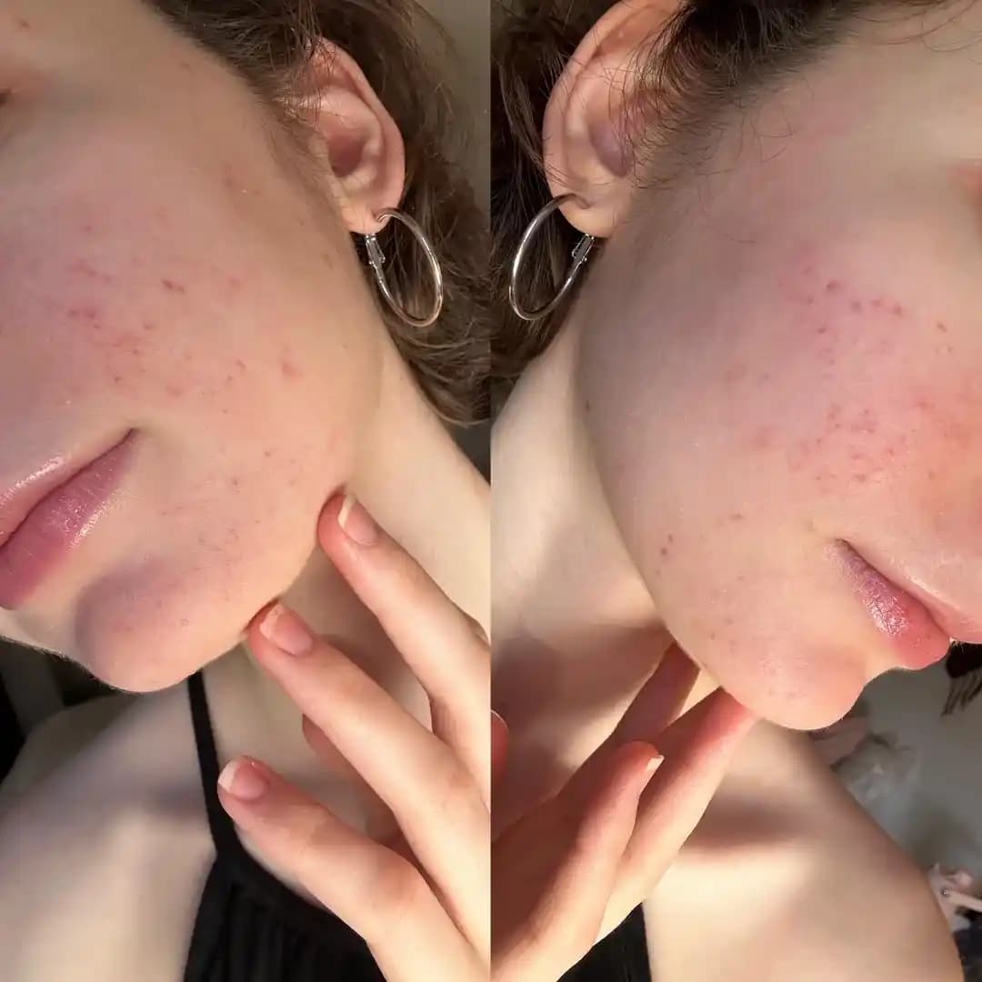 Uzun Süren Sivilce Problemleri ve Cilt Bakımında Etkili Tedavi Yöntemleri