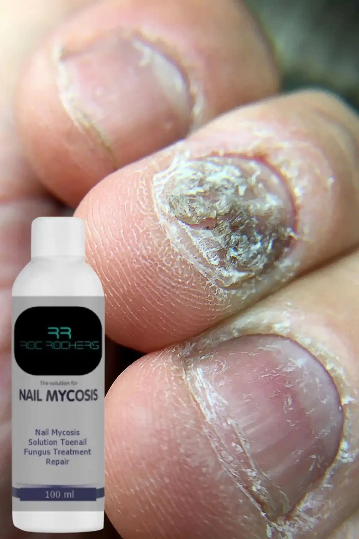 Roc Rochers Bitkisel İçerikli Tırnak Mantar Çözümü Hakkında Detaylı Bilgi