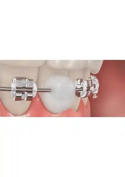 Dentalsepet Ortodonti Mumu: Bal mumu temelli, diş teli tahriş ve ağrı azaltma çözümü